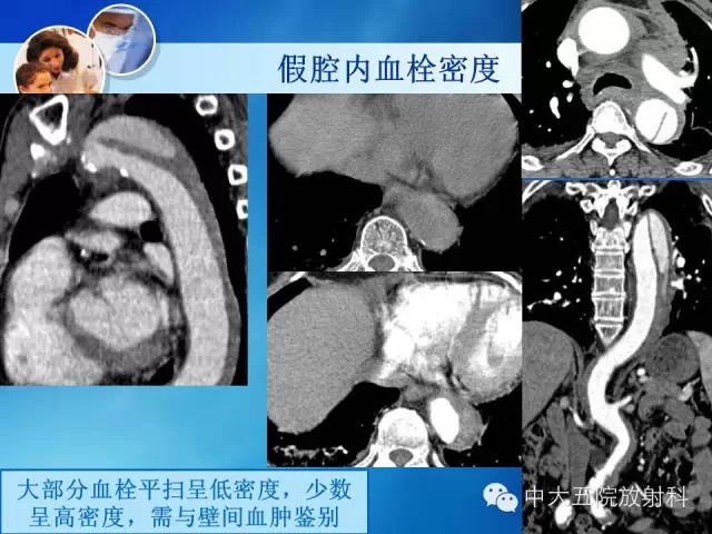 主动脉病变病理基础和影像表现