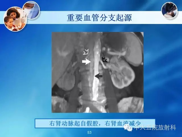 主动脉病变病理基础和影像表现