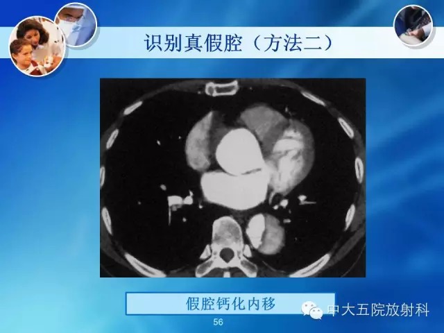 主动脉病变病理基础和影像表现
