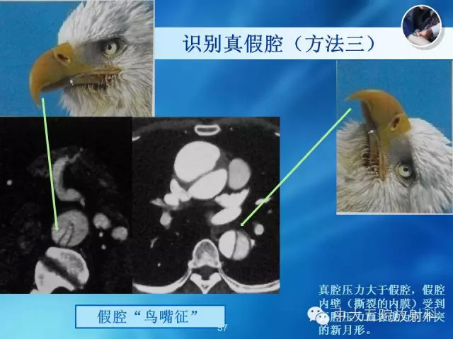 主动脉病变病理基础和影像表现