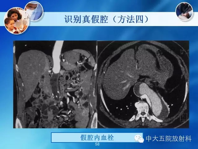 主动脉病变病理基础和影像表现