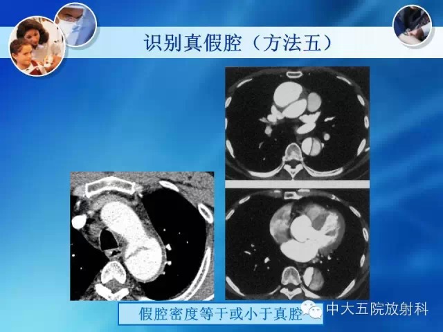主动脉病变病理基础和影像表现