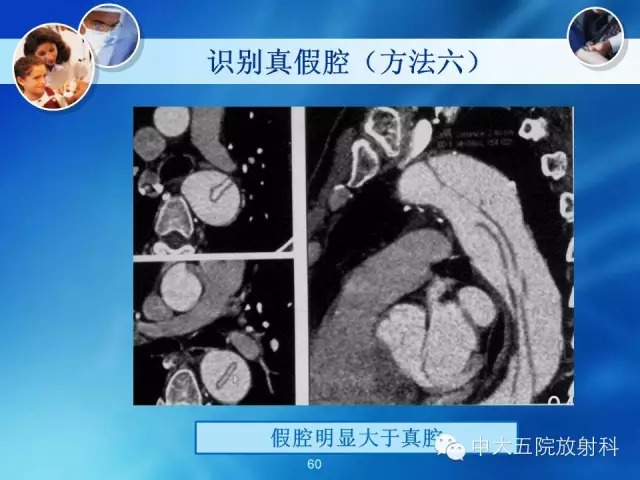 主动脉病变病理基础和影像表现