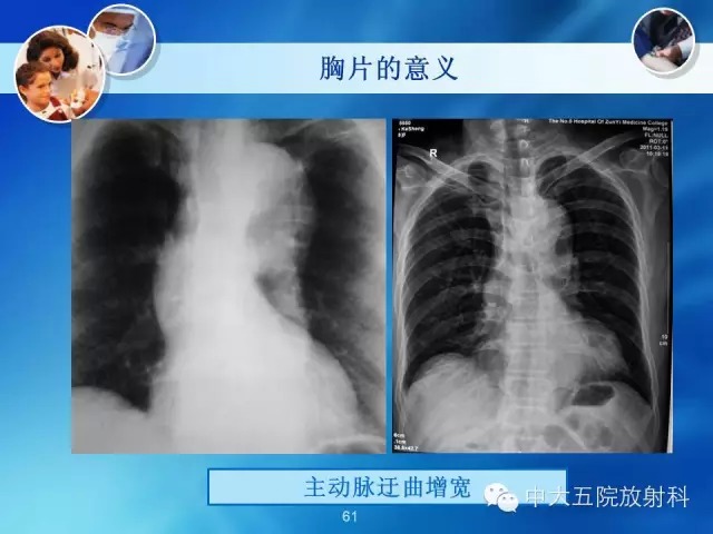 主动脉病变病理基础和影像表现