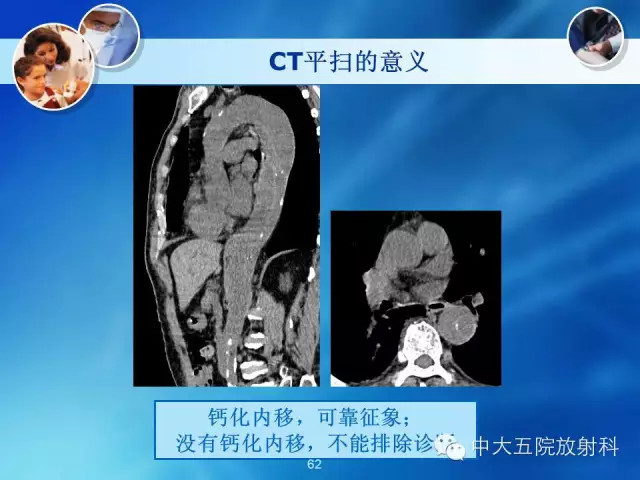 主动脉病变病理基础和影像表现