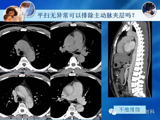 主动脉病变病理基础和影像表现