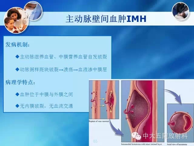 主动脉病变病理基础和影像表现