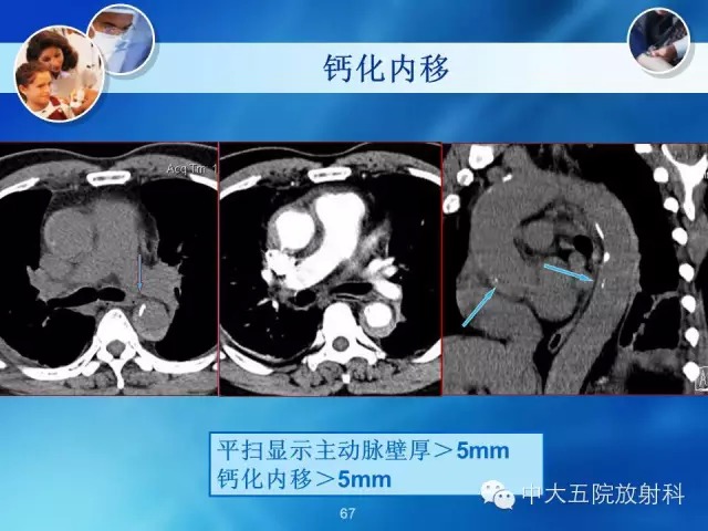 主动脉病变病理基础和影像表现