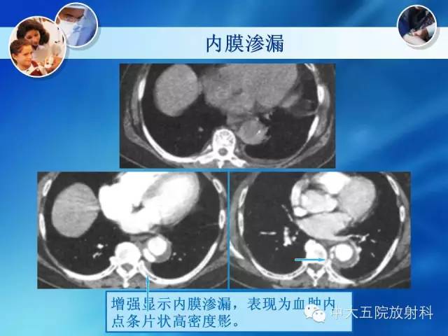 主动脉病变病理基础和影像表现