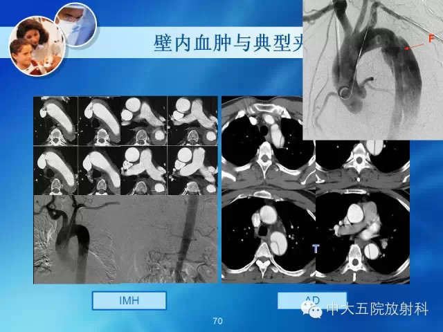 主动脉病变病理基础和影像表现