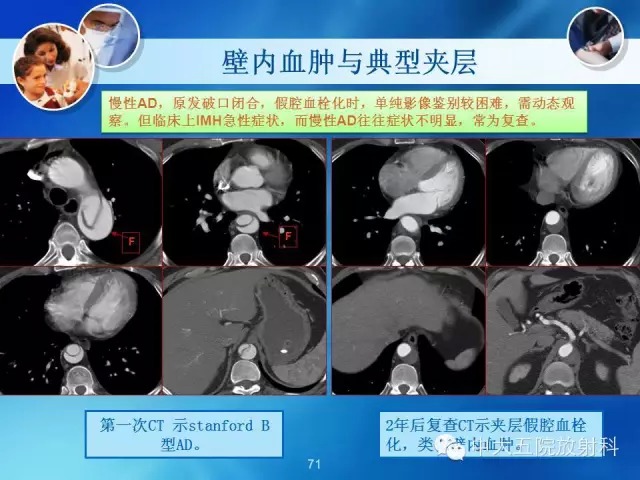 主动脉病变病理基础和影像表现