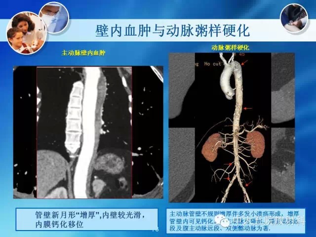 主动脉病变病理基础和影像表现
