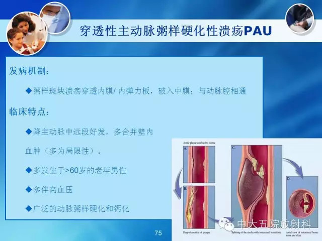 主动脉病变病理基础和影像表现