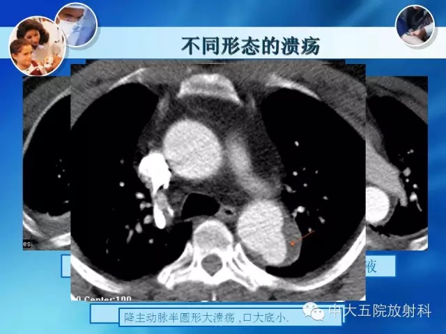 主动脉病变病理基础和影像表现