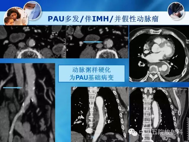 主动脉病变病理基础和影像表现