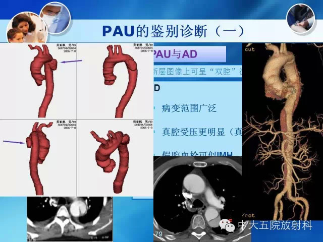 主动脉病变病理基础和影像表现