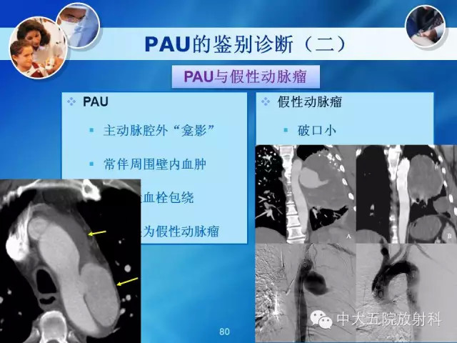主动脉病变病理基础和影像表现