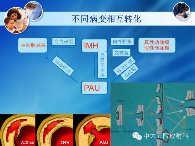 主动脉病变病理基础和影像表现