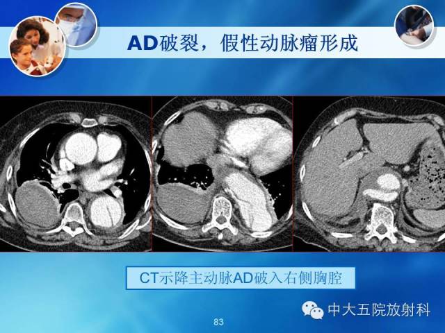 主动脉病变病理基础和影像表现