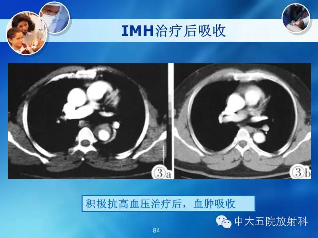 主动脉病变病理基础和影像表现