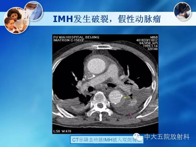 主动脉病变病理基础和影像表现