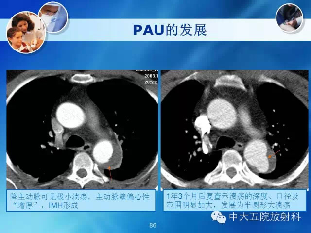主动脉病变病理基础和影像表现