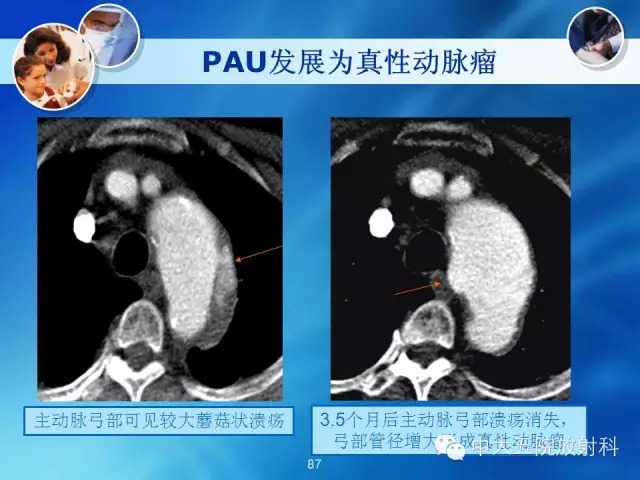 主动脉病变病理基础和影像表现