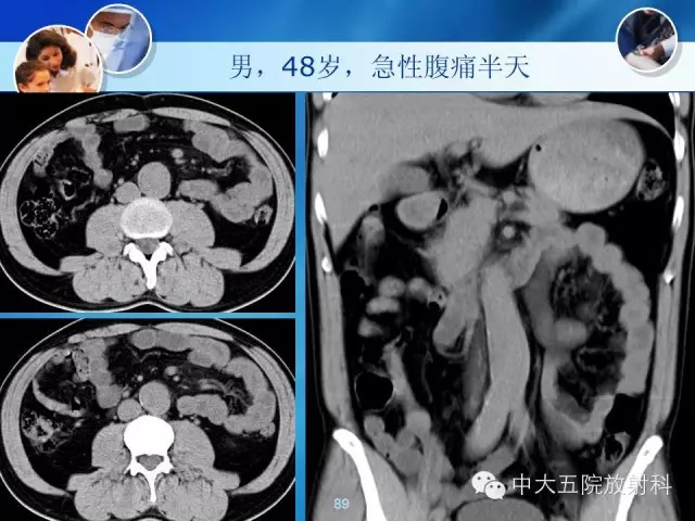 主动脉病变病理基础和影像表现