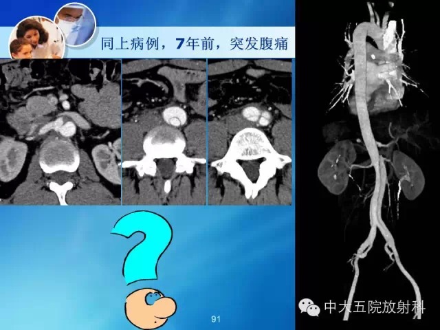 主动脉病变病理基础和影像表现