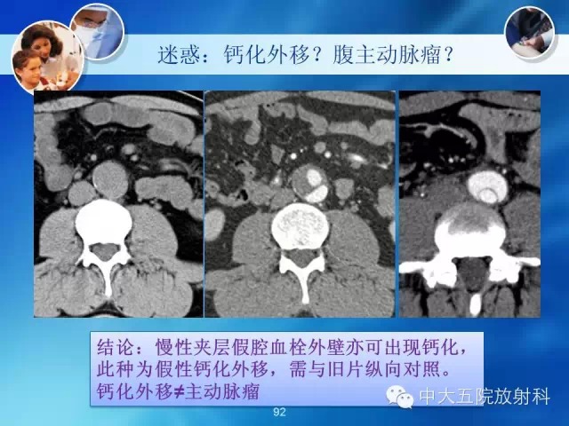 主动脉病变病理基础和影像表现