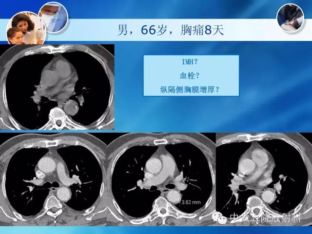 主动脉病变病理基础和影像表现