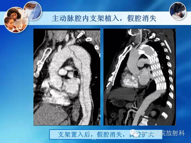 主动脉病变病理基础和影像表现