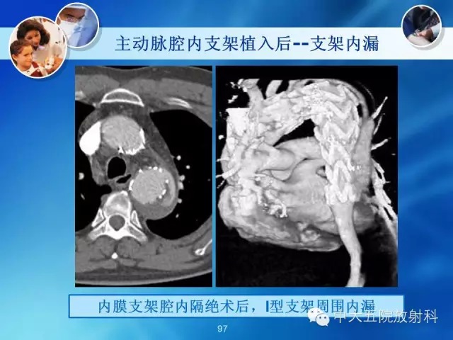 主动脉病变病理基础和影像表现