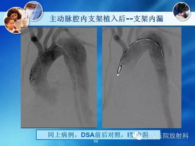主动脉病变病理基础和影像表现