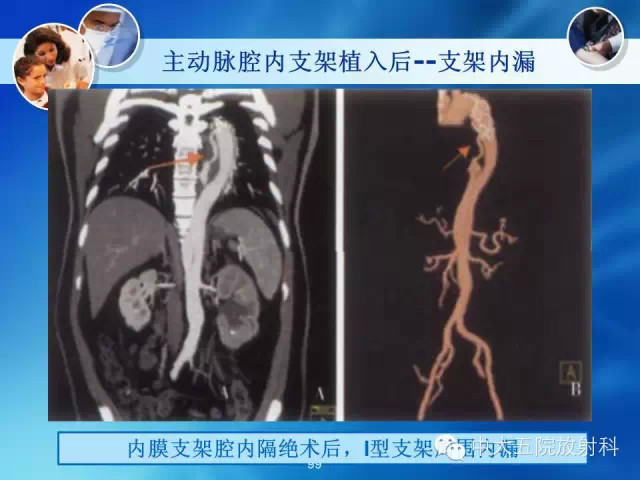 主动脉病变病理基础和影像表现