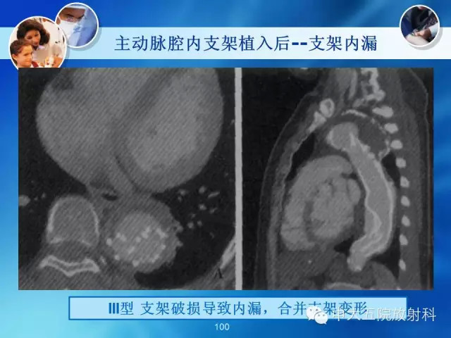 主动脉病变病理基础和影像表现