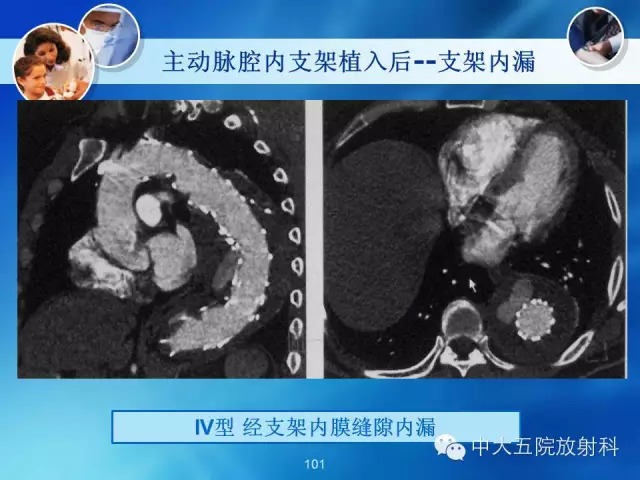主动脉病变病理基础和影像表现
