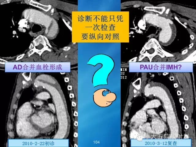 主动脉病变病理基础和影像表现