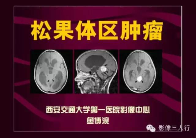 松果体区肿瘤影像诊断