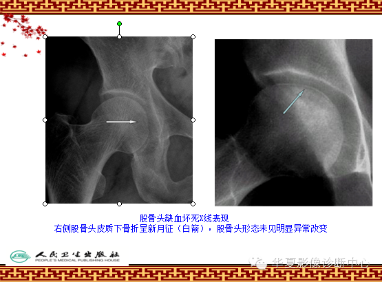 骨缺血坏死与骨梗死 的影像诊断