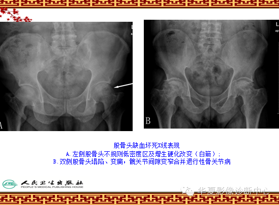 骨缺血坏死与骨梗死 的影像诊断
