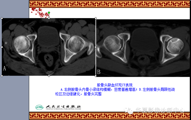 骨缺血坏死与骨梗死 的影像诊断