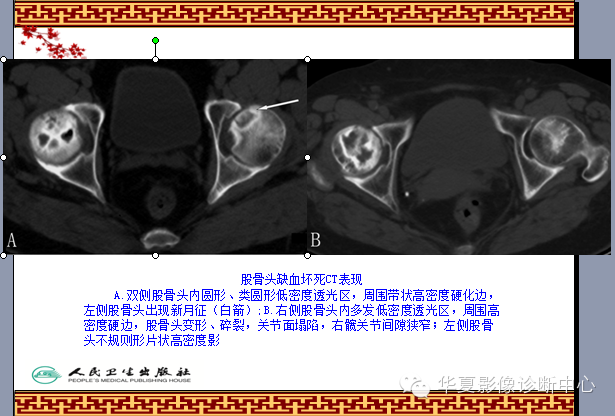 骨缺血坏死与骨梗死 的影像诊断