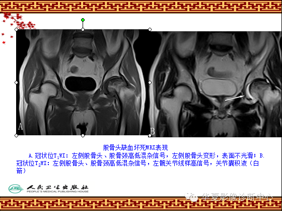 骨缺血坏死与骨梗死 的影像诊断