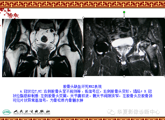 骨缺血坏死与骨梗死 的影像诊断