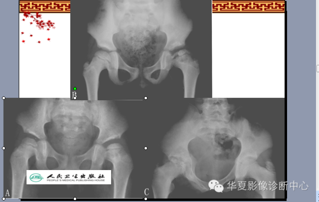 骨缺血坏死与骨梗死 的影像诊断
