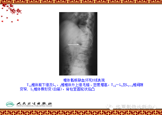 骨缺血坏死与骨梗死 的影像诊断
