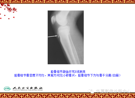 骨缺血坏死与骨梗死 的影像诊断