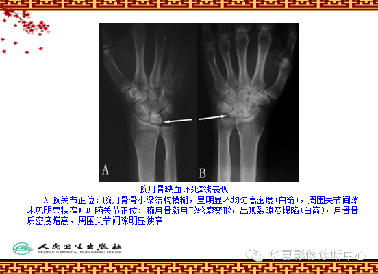 骨缺血坏死与骨梗死 的影像诊断