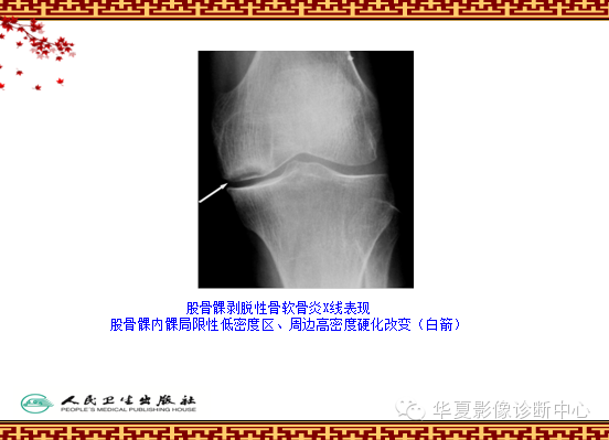 骨缺血坏死与骨梗死 的影像诊断